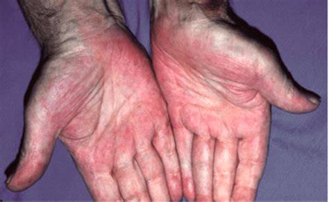 Palmar Erythema: What It Is, Causes, Pictures, Treatment