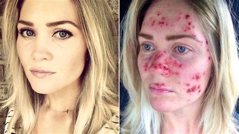 Woman's Skin Cancer Selfies Go Viral — and Inspire Skin Checks | Allure