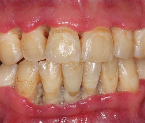 Necrotizing Periodontal Disease