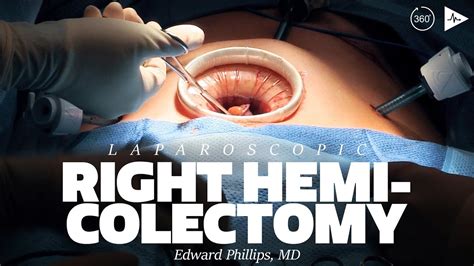 Laparoscopic Right Colectomy by Edward H. Phillips, MD | Case Trailer - YouTube