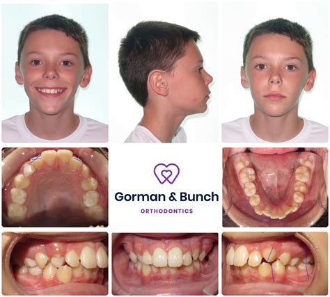 Invisalign Before And After Crowding