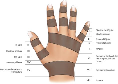 Zones of Flexor Tendon Injuries | Plastic Surgery Key