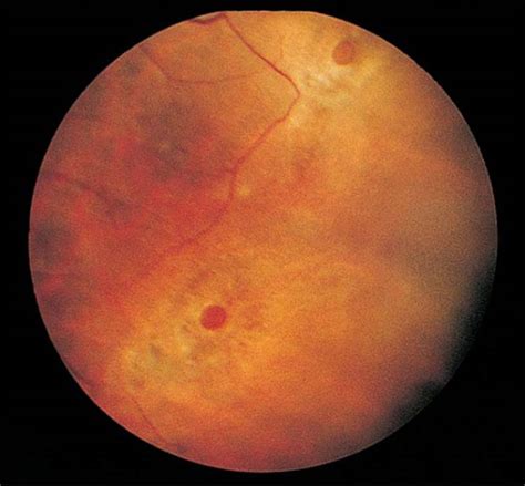 Operculated Retinal Hole In Retinal Detachment Retina