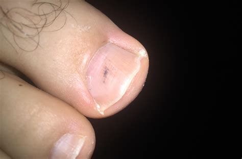 Melanoma under toenail pictures: black spot, nail melanoma pictures, toenail melanoma pictures ...