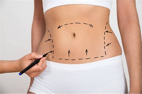 What You Need to Know About Liposuction Recovery Time