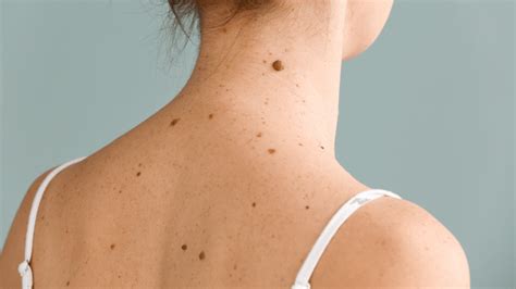 How to Remove Barnacle Spots on The Skin? | Lumenis UK