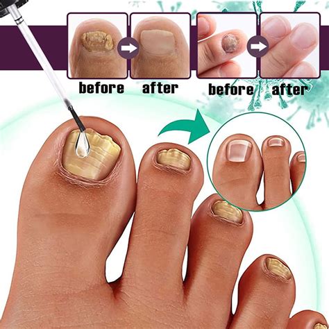 30ml Nail Fungus Treatment Serum Fast-acting Nail Discoloration Treatment for Brittle Peeling ...