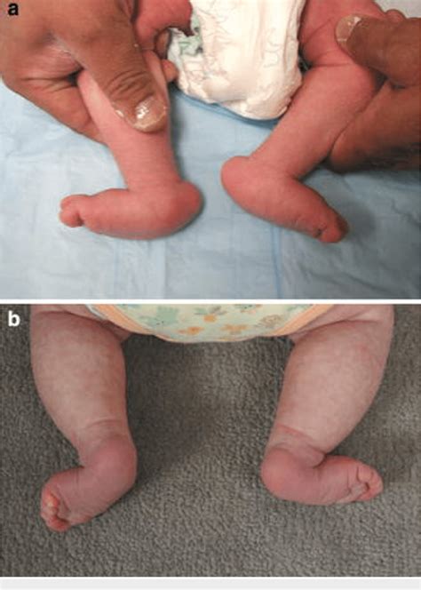 Figure 1 from Congenital Vertical Talus: An Updated Review | Semantic Scholar