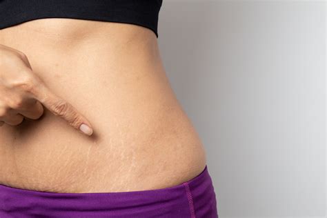 Stretch Marks: Causes, Treatment, and Prevention