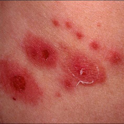 Skin Rash Shingles Symptoms