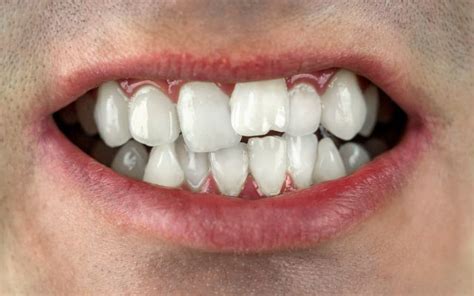 Twisted Teeth: Causes, Symptoms, Treatments & Prevention