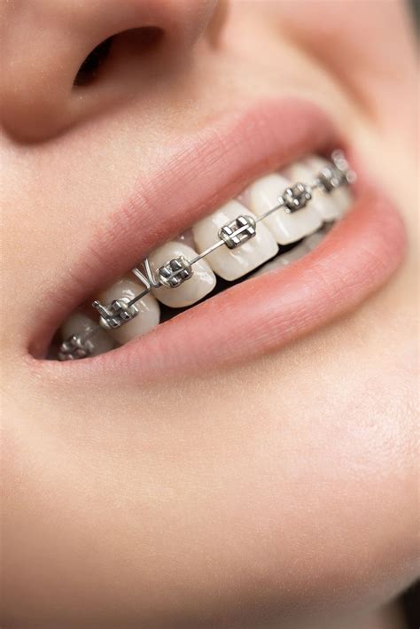 Metal Braces Treatment | Traditional Orthodontics by Dr. Gilbert