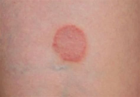 Ringworm: Images, Causes, Symptoms, Treatment - YouMeMindBody