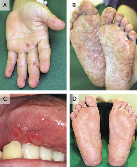 Hand Foot And Mouth Disease Hfmd Human Hand Of Scarlet Fever On Palm ...