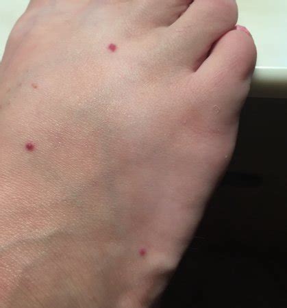 Small tiny pinpoint red dots on skin - kizacenters