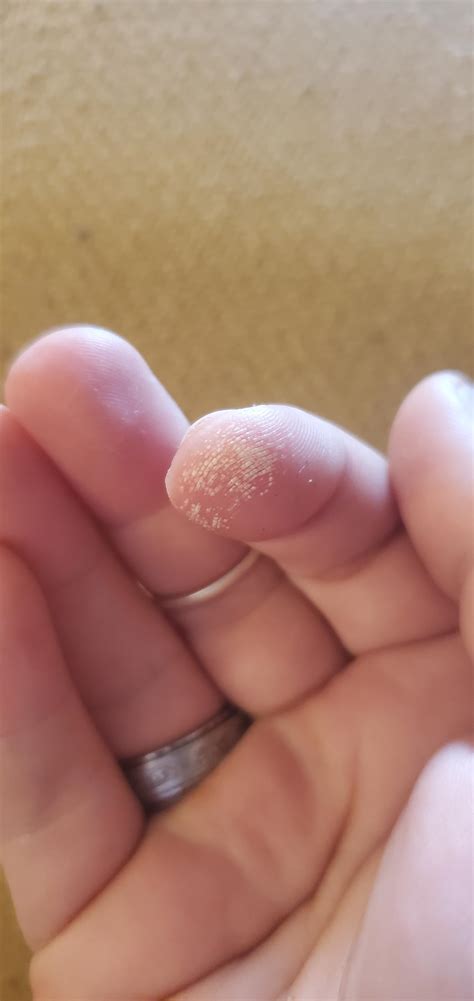 Anyone know why peroxide does this to my skin? : r/skin