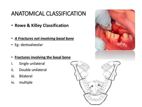 Classification of Mandible, Midface, ZMC and NOE Fractures