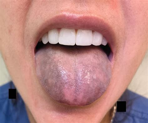 Tongue Discoloration | NEJM | Oral health, Health science, Healthcare professionals