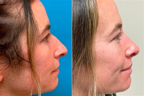 Bulbous Tip Before and After Photos - Becker Rhinoplasty Center