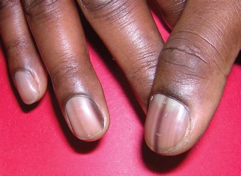 Evaluation of Nail Abnormalities | AAFP