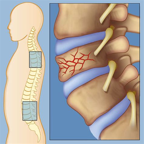 Pin by Healing Touristry on Congenital Spine Cord Malformations Treatment | Spines, Medical ...