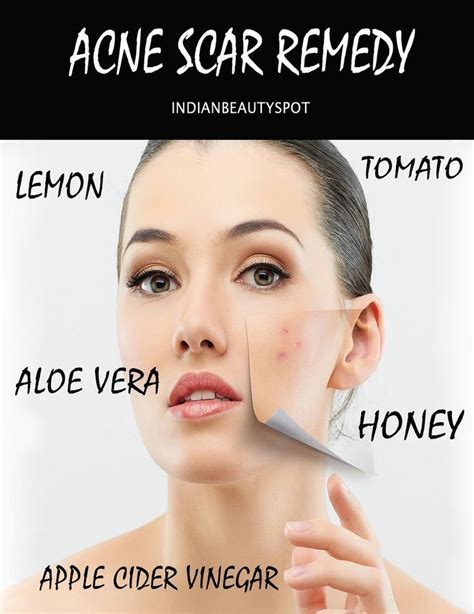 Pin on Real Acne Tips