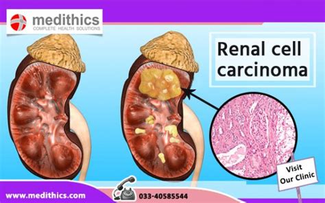 Renal Cell Carcinoma- Symptoms, Causes, Diagnosis & Treatment