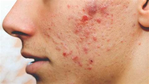 Matchless Info About How To Cure Chin Acne - Policebaby25