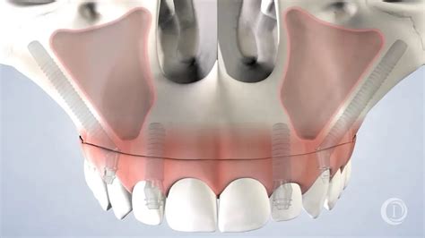 Zygomatic Implants at Innovative Oral Surgery & Dental Implants - YouTube