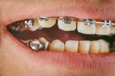 Dental Appliance and Braces Stock Photo - Image of dentistry, closeup ...