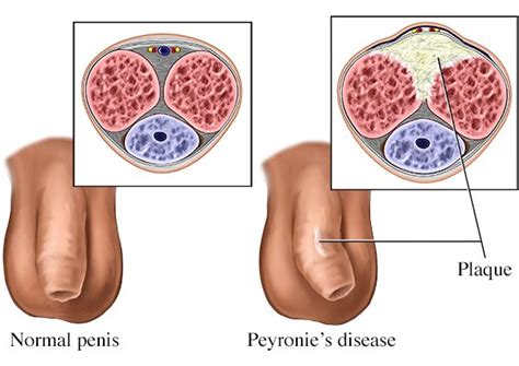 Peyronie’s disease – plastic sclerosis of the penis. Causes, symptoms ...