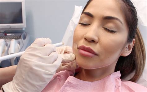 Restylane Contour Dermal Filler | San Diego, CA | CLDerm