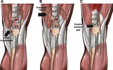 (A) The semitendinosus tendon is passed through the transverse tunnel,... | Download Scientific ...