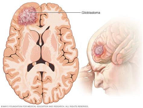 An Informatics Based Assessment of Shifts in Glioblastoma Diagnosis ...