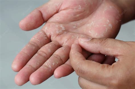 These serious reasons can be behind the peeling of the skin on the hands; Know the right ...