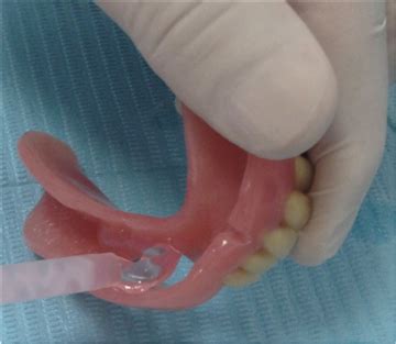 Fenestrated Denture: A Grace Option To Edentulous Patient