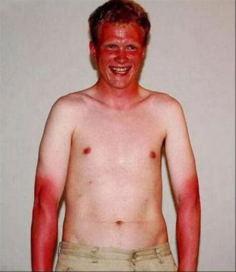 Worst And Funniest Sunburn Ever - Mirror Online