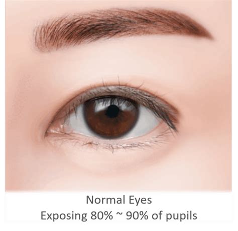 Ptosis: Causes, Treatment And More! | Dream Plastic Surgery