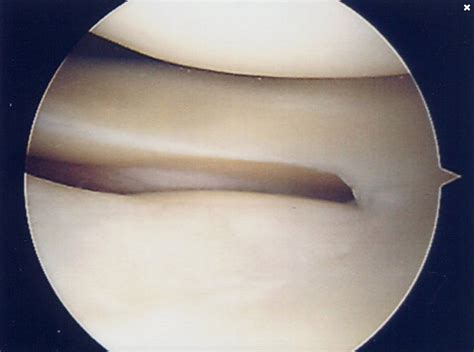 Knee Arthroscopy — Amir Qureshi Orthopaedic Surgeon | Knee Surgeon ...