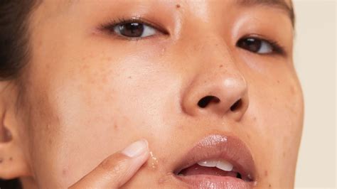 The 16 best acne spot treatments of 2023 for pimple free skin | CNN Underscored