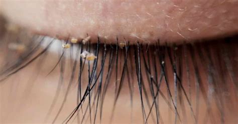 Eyelash Extensions Harbor Lice, Here's What You Need To Do