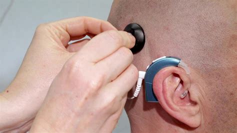 How do Cochlear Implants Work? - Cochlear Implants