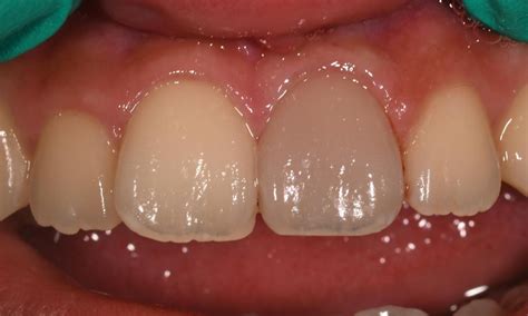 WinningSmiles Dentistry | Smile Gallery | Internal Bleaching