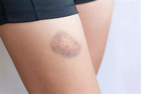 Blood clot or bruise? Know the symptoms to tell them apart