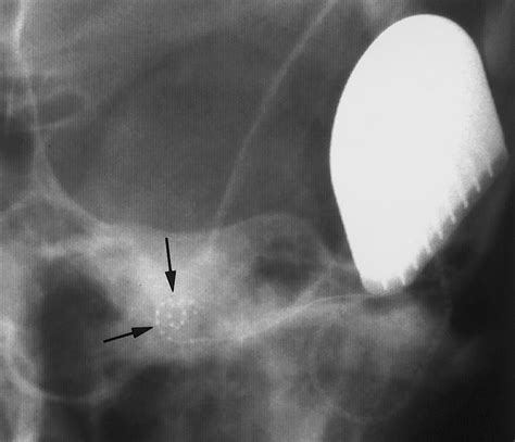 Pediatric and Adult Cochlear Implantation | RadioGraphics