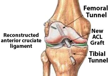 ACL Reconstruction Grafts – CoreNewport