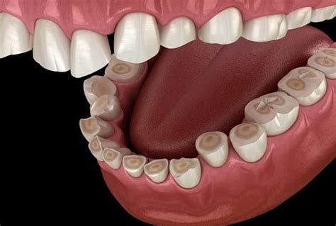 Tooth Erosion | The Dental Arcade – Blog