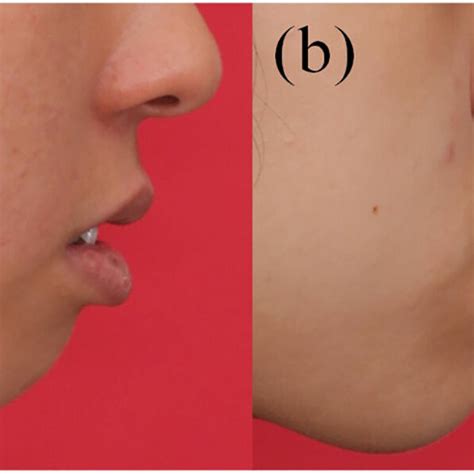 Strained lip in (a) mandibular hypoplasia, (b) mandibular hyperplasia ...