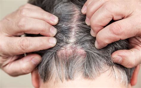 Causes of Scalp Scabs and How to Treat Them | Hiswai