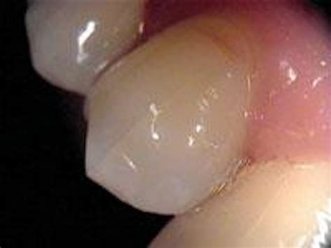 Cracked tooth syndrome | Dentistry IQ